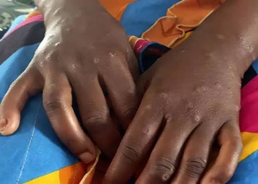 Madagascar sous pression : plus de 2 000 cas de Mpox recensés depuis 2025